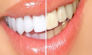 Mô tả các nguyên tắc hoạt động của dải làm trắng răng