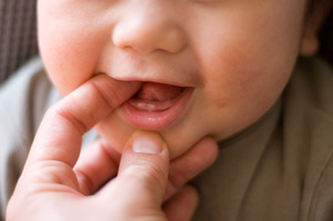 Những cách giúp trẻ làm răng