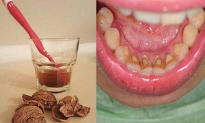 Phương pháp dân gian đối phó với cao răng