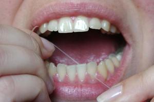 Loại bỏ sỏi trên răng tại nhà