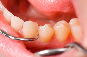Tại sao cao răng xuất hiện