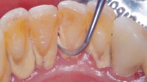 Cách tẩy đá bằng muối