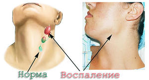 Tại sao hạch bạch huyết bị viêm