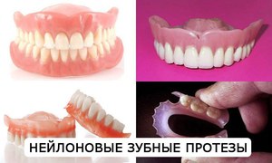 Răng nylon có thể tháo rời - tùy chọn phục hình