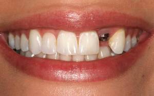 Phân loài abutment và đặc điểm của chúng