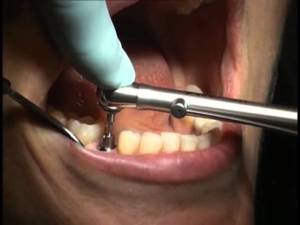 Mô tả các phương pháp sửa chữa trụ cầu cho cấy ghép