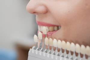 Lựa chọn veneer theo màu sắc