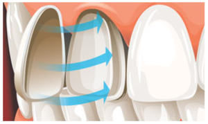 Vấn đề xuất hiện răng được giải quyết bằng veneers.