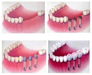  Chi phí của veneers phụ thuộc vào vật liệu.