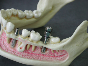 Nẹp cáp Chân giả trước khi veneers