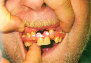 Cách lắp đặt răng giả