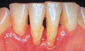 Chống chỉ định với việc sử dụng răng giả nylon