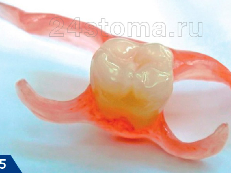 Hàm giả nylon cho một răng Hàm răng giả đơn
