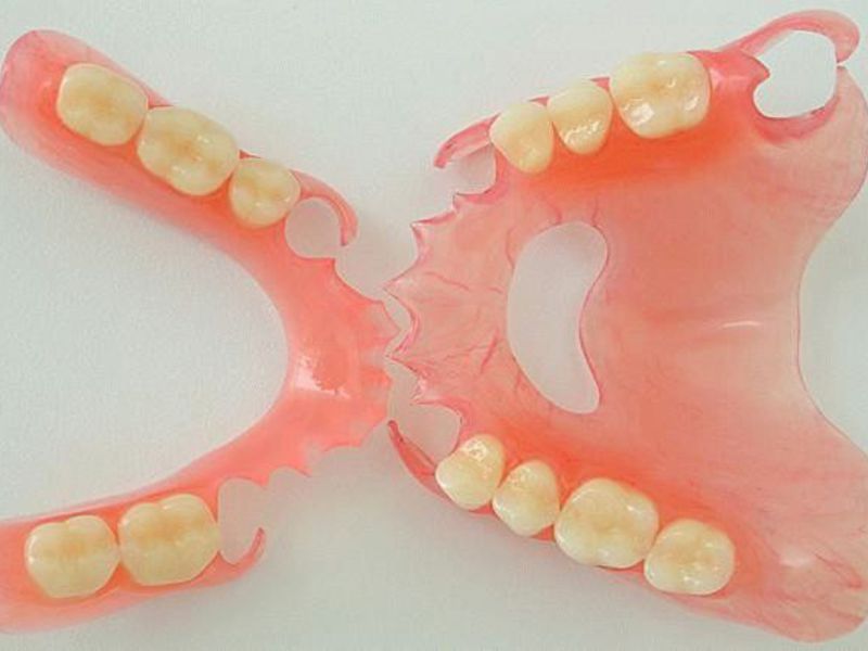 Phục hình nylon với sự hiện diện của khuyết tật răng Làm răng giả nylon trong bao lâu