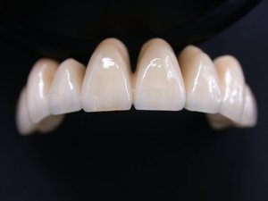 Các loại gốm kim loại