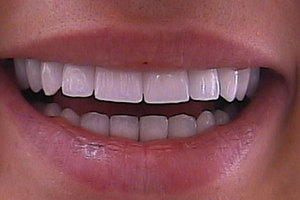 Cấy răng cửa