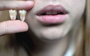 Đặc điểm của mọc răng khôn