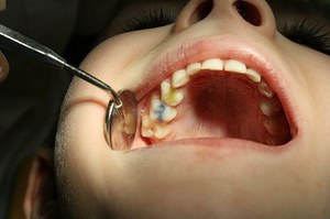 Mô tả các bệnh lý tăng trưởng không chính xác của họa sĩ thứ ba