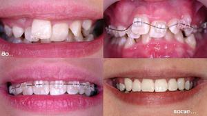 Cách khắc phục vết cắn