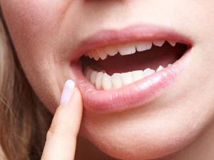 Làm gì với viêm miệng
