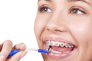 Cách đeo niềng răng