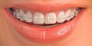 Nụ cười hoàn hảo sau khi niềng răng