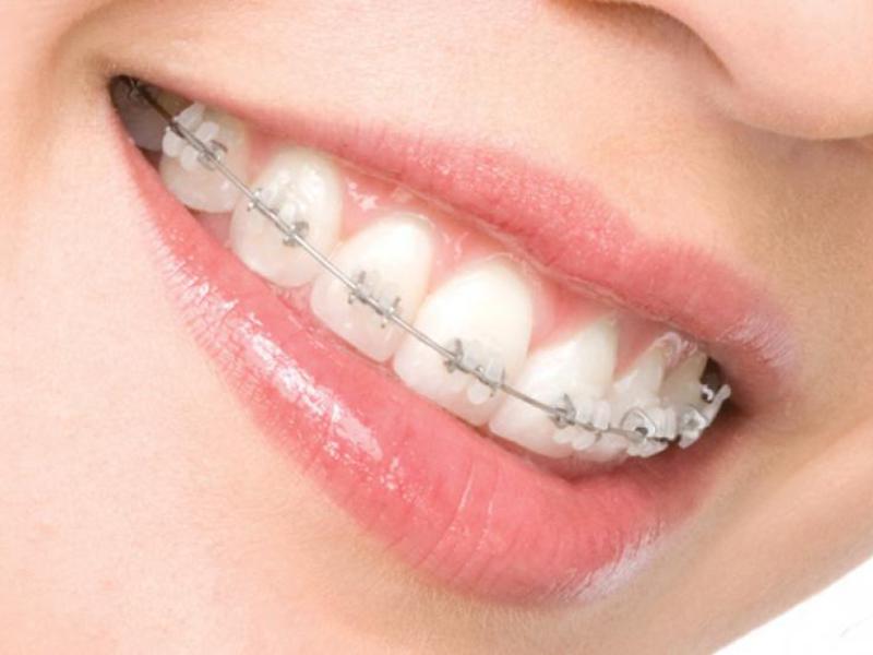 Cách cài đặt niềng răng sapphire Sapphire niềng răng trong miệng