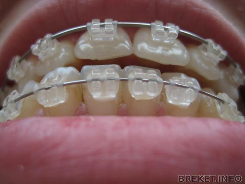 Quá trình căn chỉnh răng với niềng răng sapphire Niềng răng Sapphire
