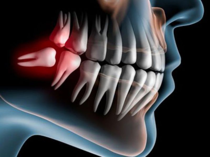 Cắt răng cuối cùng Khi răng khôn mọc lên