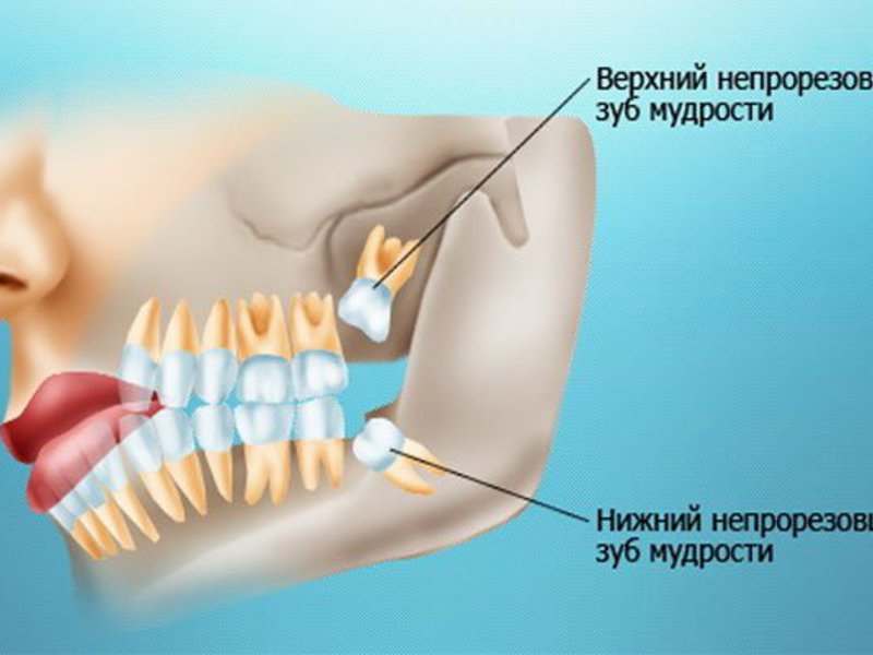 Răng khôn Làm thế nào để đối phó với răng khôn