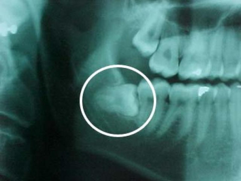 Ảnh chụp răng khôn Ví dụ về vị trí của răng khôn
