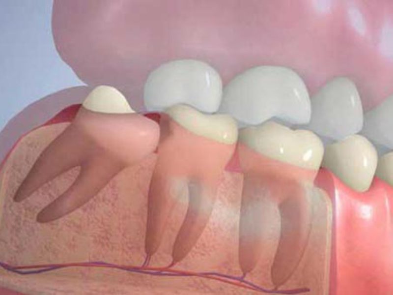 Điều trị hoặc loại bỏ răng khôn Cách trị răng khôn