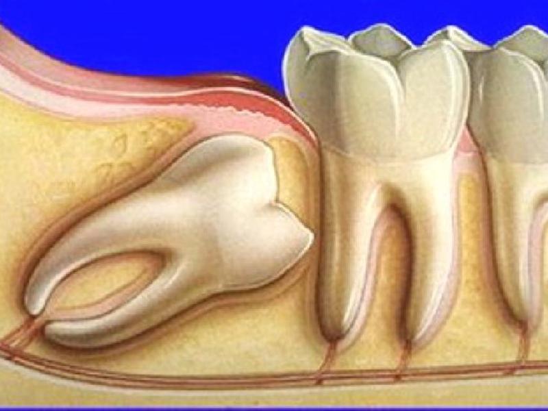 Vị trí của răng khôn Vị trí chính xác của răng khôn