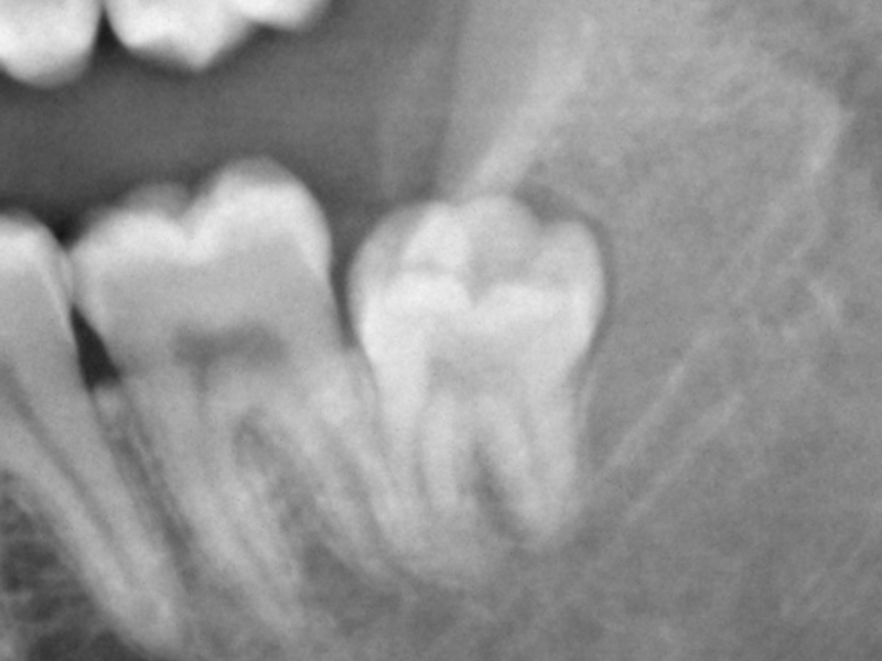 Ảnh chụp răng khôn Răng khôn trông như thế nào