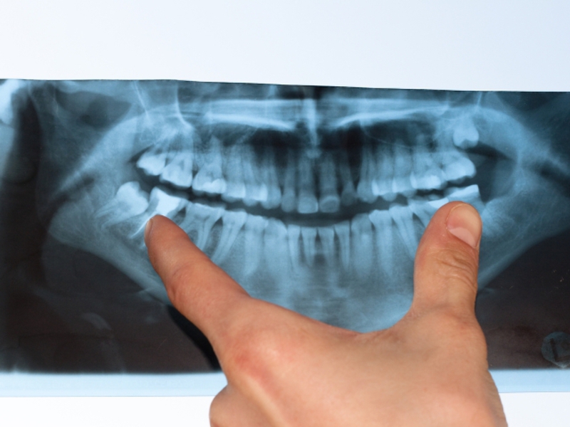 Làm thế nào để đối phó với răng khôn Ảnh chụp răng khôn