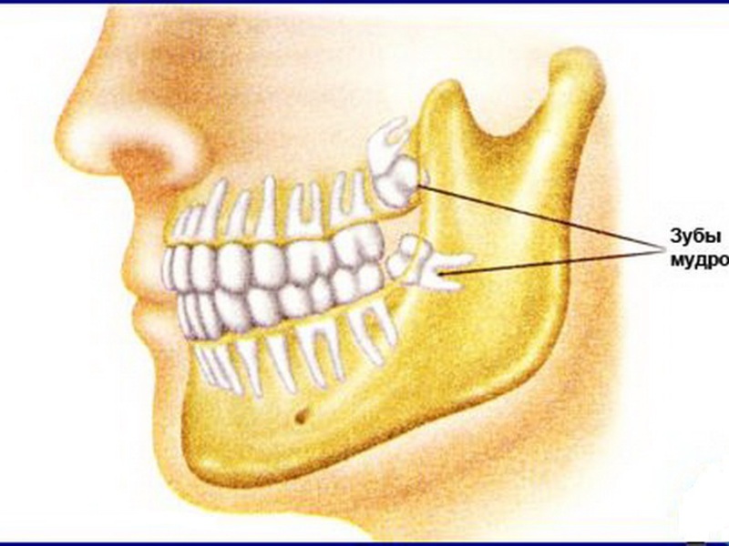 Làm thế nào được nếu răng khôn đau Răng khôn cắt qua