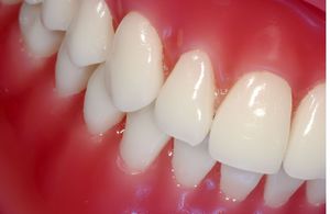 Chúng tôi điều trị kẹo cao su dân gian