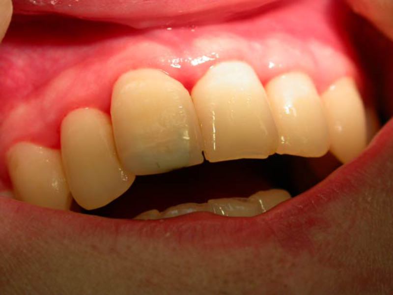 Đau nướu Nướu bị viêm