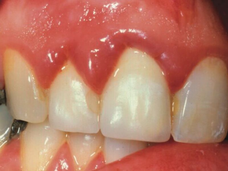 Bệnh nướu răng Bệnh nướu răng ở người lớn