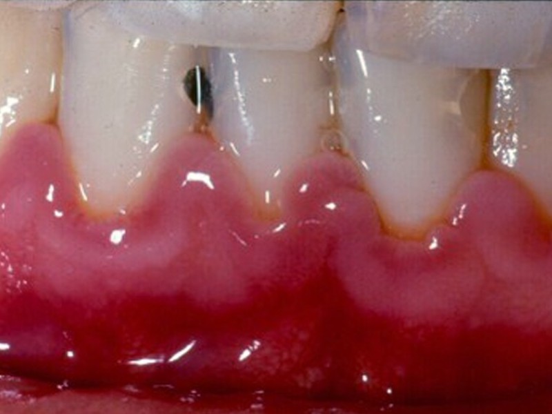 Nướu bị viêm Điều trị kháng sinh nướu răng