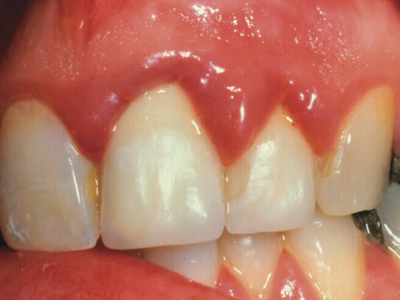 Bệnh nướu răng Cách điều trị nướu răng