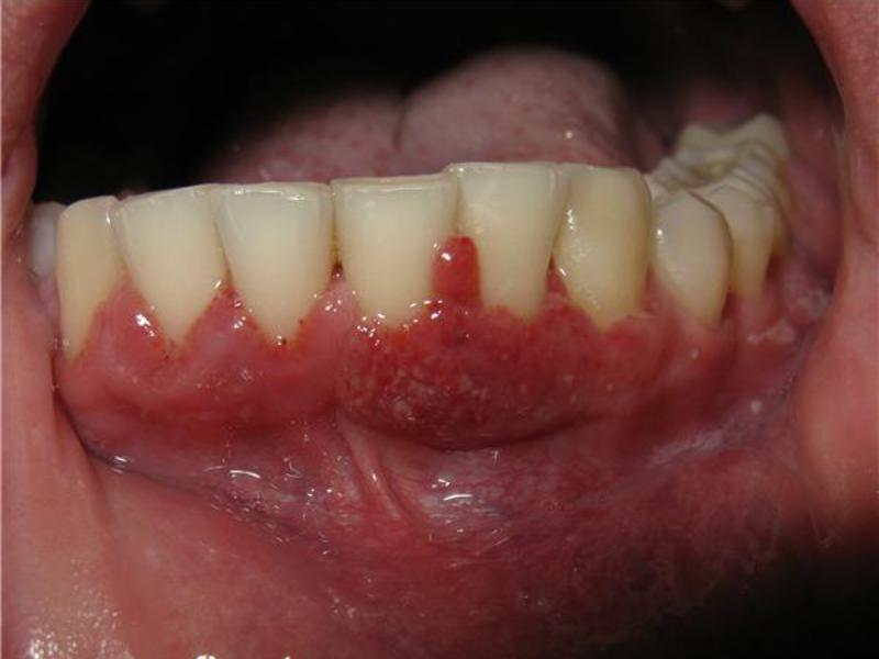 Điều trị đau nướu Cách súc miệng đau nướu