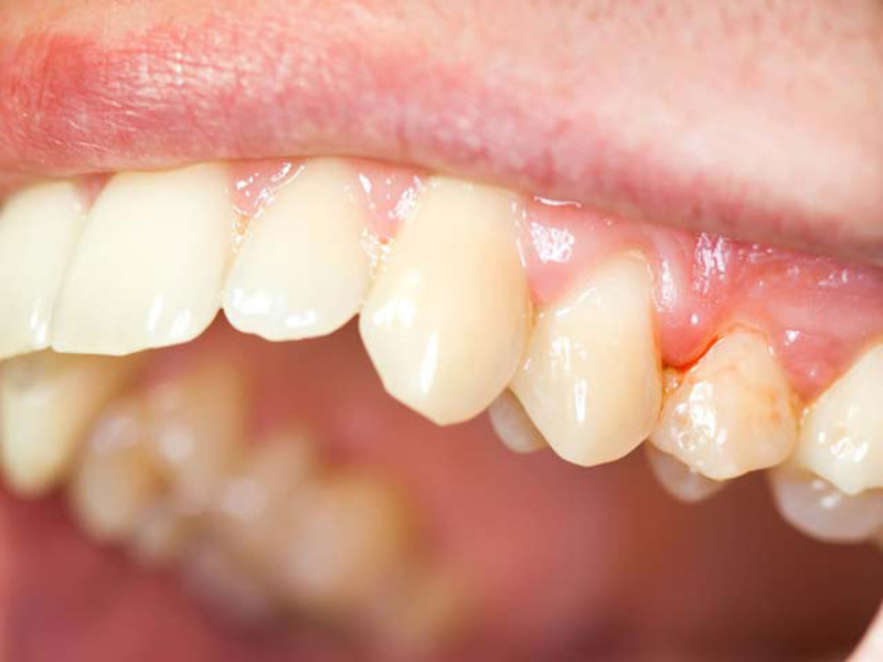 Cách điều trị đau nướu Cách loại bỏ viêm nướu