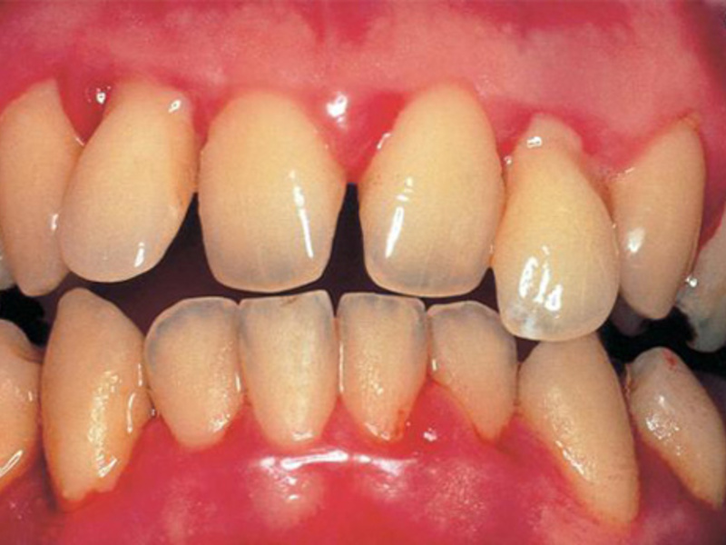 Loại bỏ quá trình viêm Làm thế nào để loại bỏ quá trình viêm