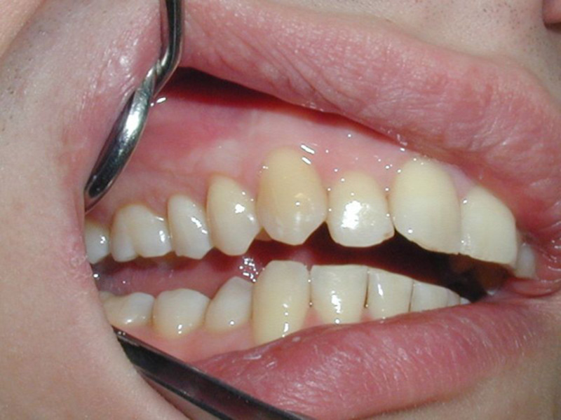 Điều trị bệnh nướu Viêm nướu
