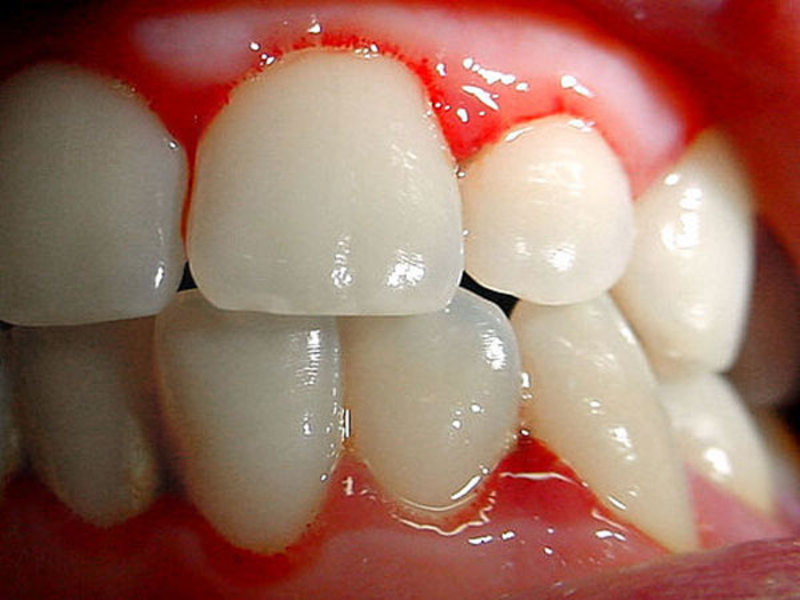 Bệnh nướu răng và điều trị Điều trị đau nướu